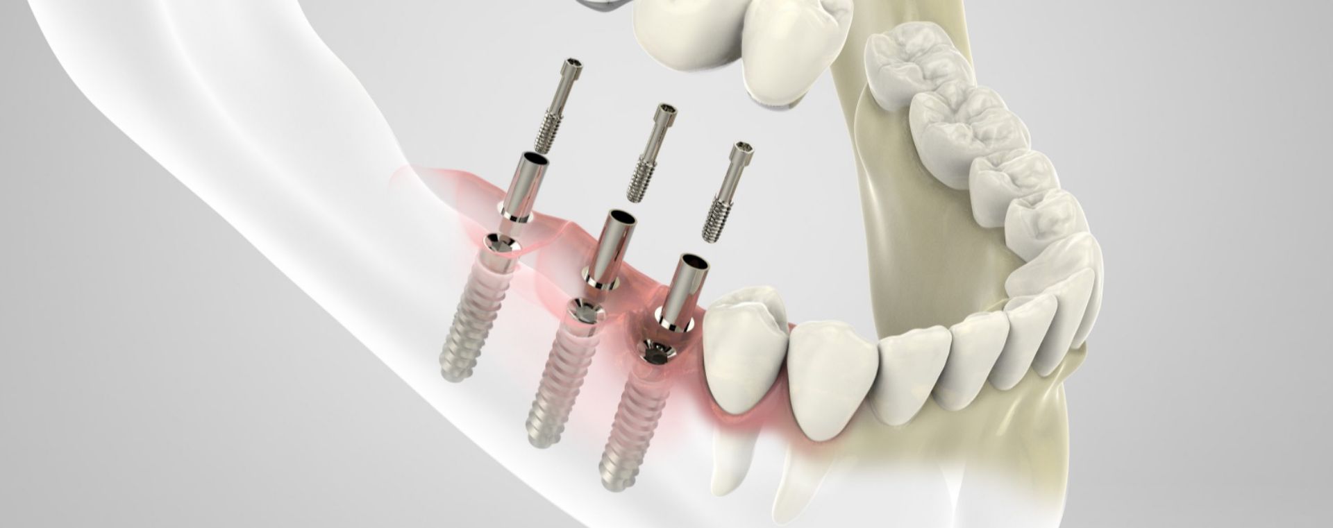 Clinica-Odontoiatrica-Mancini-implantologia